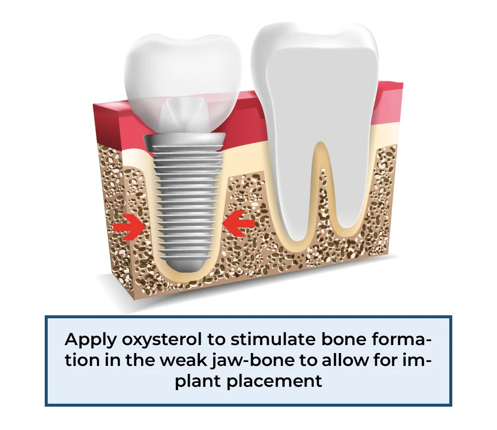Dental implant