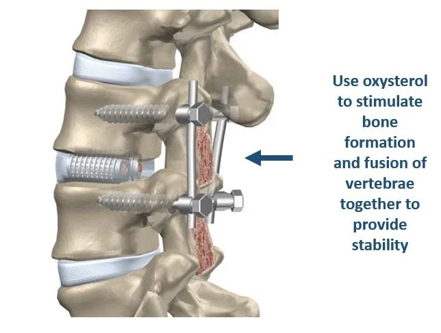Spinal Fusion