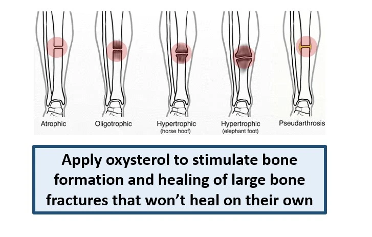 Nonunion bone fracture