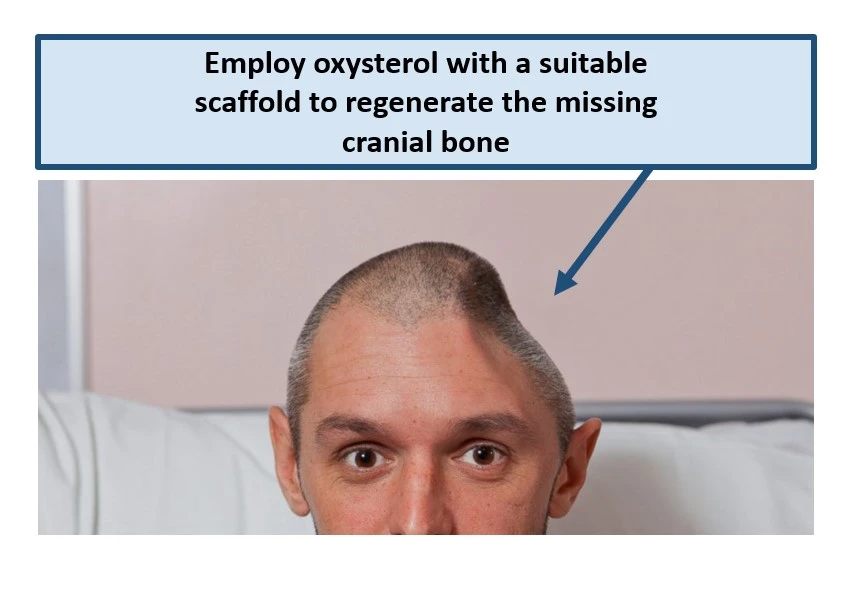 Maxillofacial Bone Regeneration